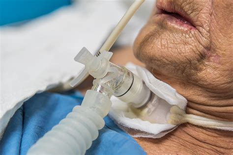 Comparing Tracheostomy Tube Decannulation Protocols in Critically Ill Patients - Pulmonology Advisor