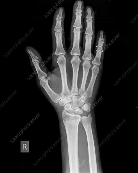 Distal radius fracture, X-ray - Stock Image - C056/4180 - Science Photo ...