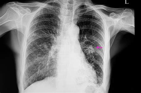 World Pneumonia Day: Little-known facts and figures about this lung ...