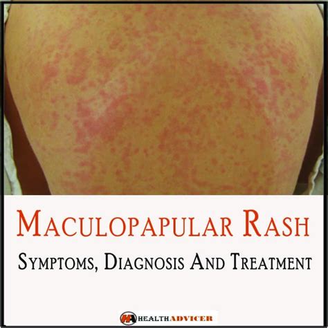 Maculopapular Rash: Causes, Symptoms And Treatment