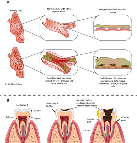 Biofilms and their role in pathogenesis | British Society for Immunology