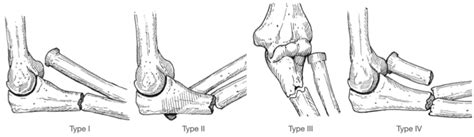 Bado Classification • LITFL • Medical Eponym Library