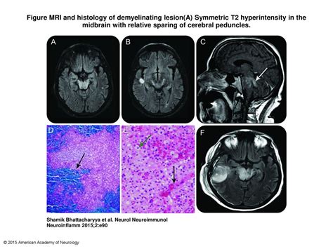 Figure MRI and histology of demyelinating lesion(A) Symmetric T2 ...