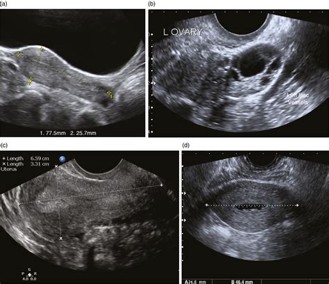 Normal Pelvic Ultrasound