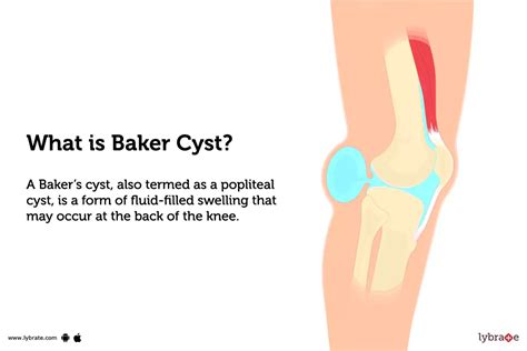 Baker Cyst: Causes, Symptoms, Treatment and Cost