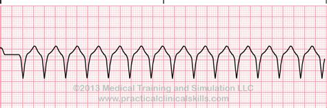 Ventricular Tachycardia EKG Interpretation with Rhythm Strip