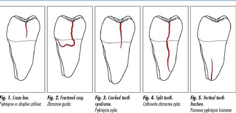 [PDF] Cracked Tooth Syndrome as a major issue of today’s patients ...