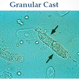 Granular Cast | Medical Laboratories