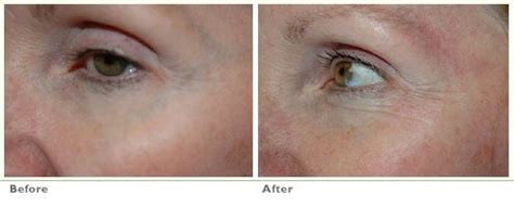 Sclerotherapy Under Eye Vein Removal - Blue Veins Under Eye