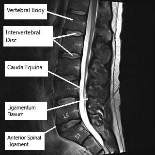 Lumbar Spine Mri Labeled