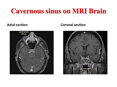 Cavernous sinus thrombosis.pdf ppt