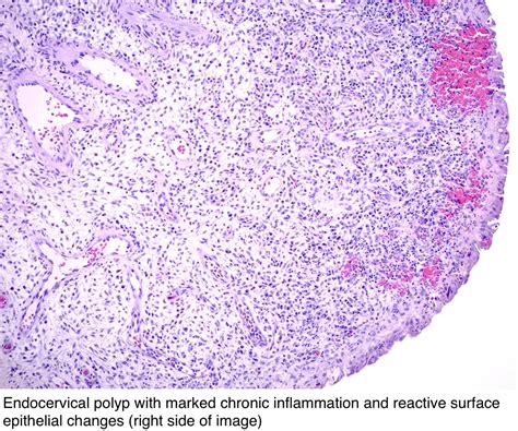 Pathology Outlines - Endocervical polyp