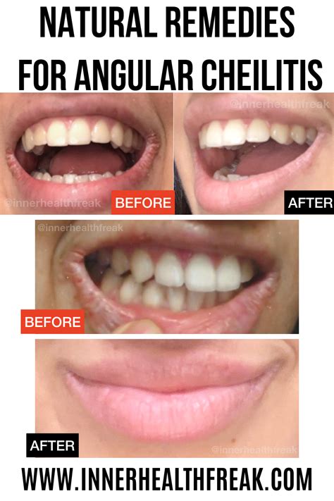 Angular Cheilitis Natural Treatment - Pregnant Center Informations