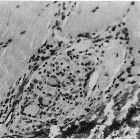 Angiolymphoid hyperplasia with eosinophilia. 1a – clinical close up of ...