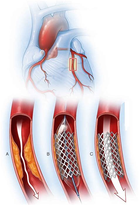 PTCA procedure, percutaneous coronary angioplasty, benefits & risks