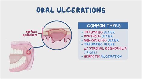 Mouth Ulcers