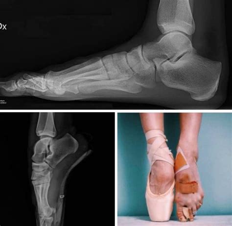 What does a ballerina’s foot look like on an X-ray? Orthopaedic Specialists