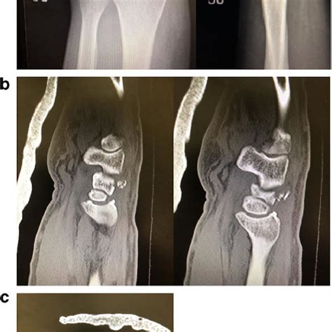 Triquetral Fractures Overview