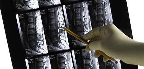 What Is a Disc Extrusion? – Arnold & Itkin