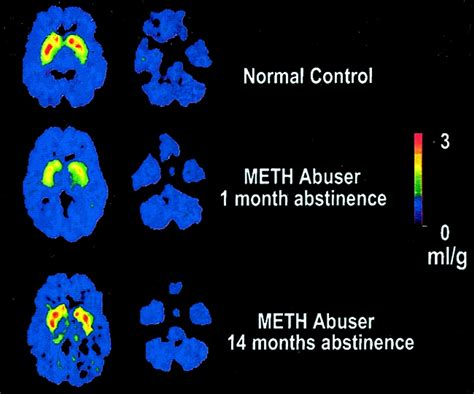 Effects Of Meth On The Brain