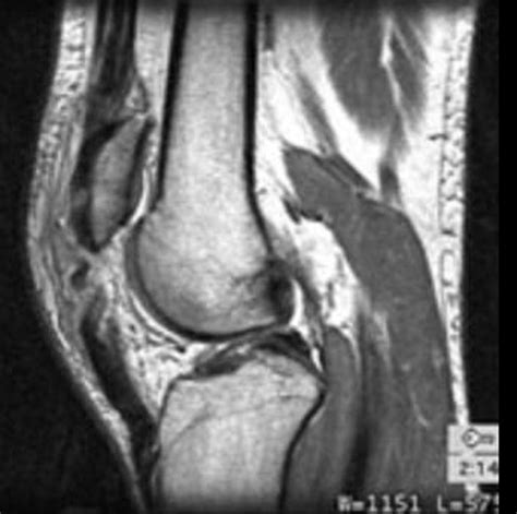 Patellar tendon rupture - wikidoc