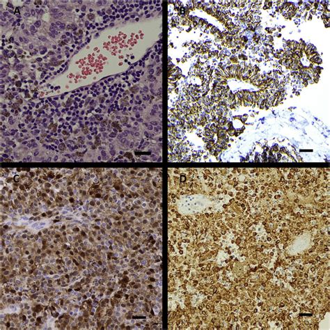 Histologic features supporting the diagnosis of malignant melanoma. (a)... | Download Scientific ...