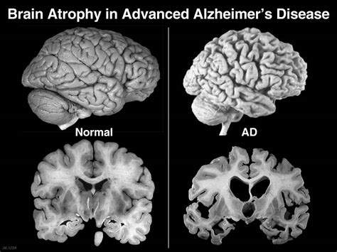 Iron Levels Can Predict Alzheimer's Disease - The Gazette Review