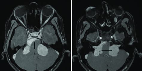 (a). T1 weighted MRI image showing a mass lesion in the right CP angle... | Download Scientific ...