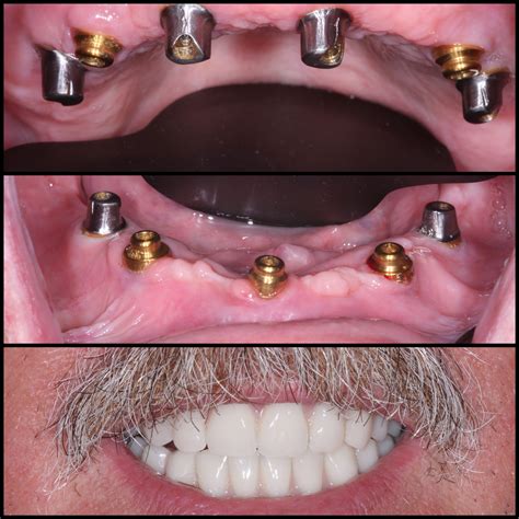 Implant Dentures that snap onto the dental implants allow this patient to eat whatever he wants ...