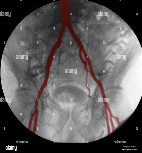 Angiogram of Iliac Arteries Stock Photo - Alamy