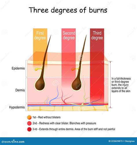 3rd Degree Burn Diagram