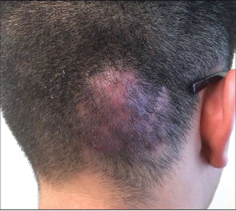 Swelling and Erythema of the Scalp on a Teenager | AAFP