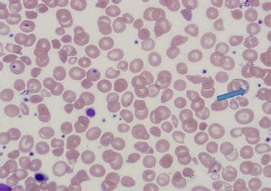 Thalassemia Intermedia: Practice Essentials, Pathophysiology, Prognosis