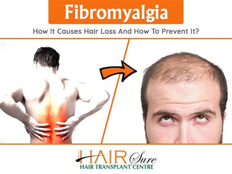 Fibromyalgia How It Causes Hair Loss And How To Prevent It? - Cyber ...