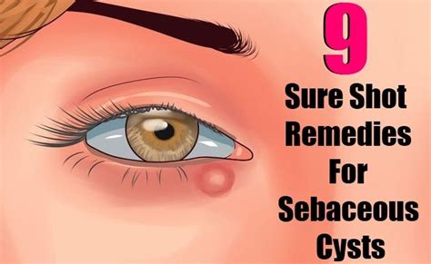 9 Sure Shot Remedies For Sebaceous Cysts | Eye cyst remedies, Cysts ...