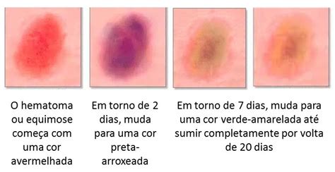 Fisioterapia em Pós Operatório de Cirurgias Plásticas: Hematoma ou ...