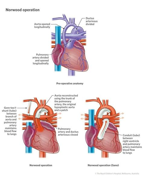 Norwood with Sano shunt (RV to PA conduit) | Cardiology, Medical school ...