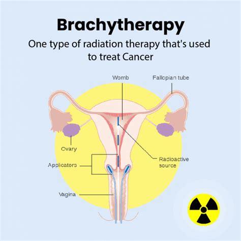 What Is Brachytherapy? | Eternity Life Tourism