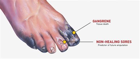 Diabetes and Amputation: A Matter of Life and Limb