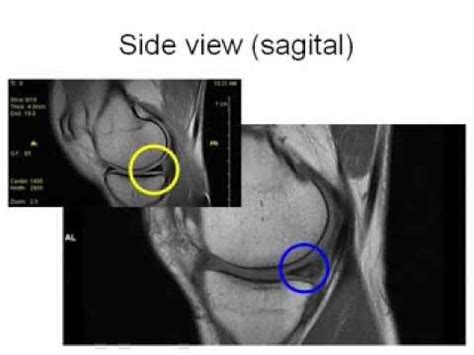 How to Read Knee MRI of Torn Meniscus | Meniscal Tear | Santa Fe ...