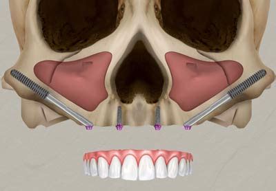 Zygomatic implants