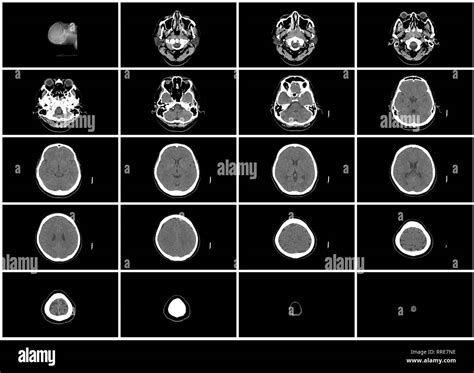 Ct head scan hi-res stock photography and images - Alamy