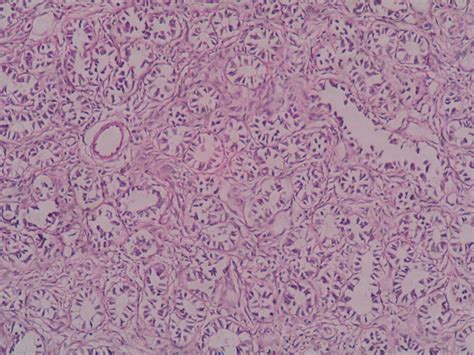 Tubular adenoma – Histopathology.guru