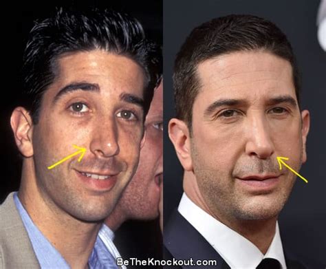 David Schwimmer Plastic Surgery Comparison Photos