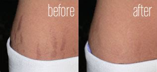 Laser Treatments in Uk: Laser Stretch Marks Removal and Laser Treatments