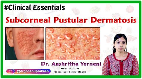 Subcorneal Pustular Dermatosis ( Clinical Essentials ) : Dr. Aashritha yerneni - YouTube