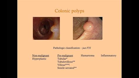 Colon Disorders and Surveillance - CRASH! Medical Review Series - YouTube