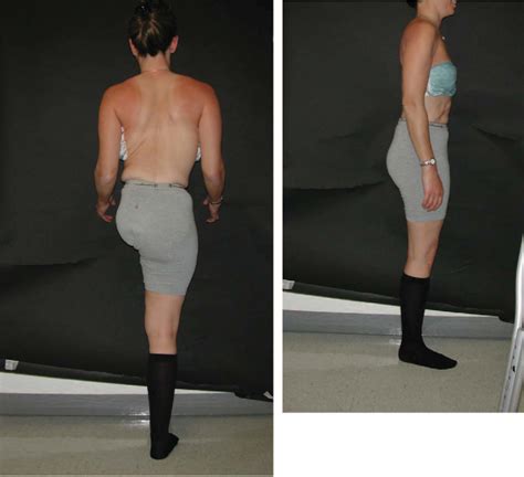 Figure 6 from Scoliosis after extended hemipelvectomy. - Semantic Scholar