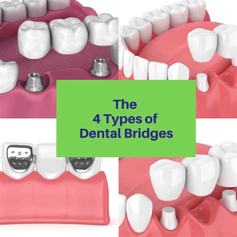 4 Types of Dental Bridges - Laurich Dentistry