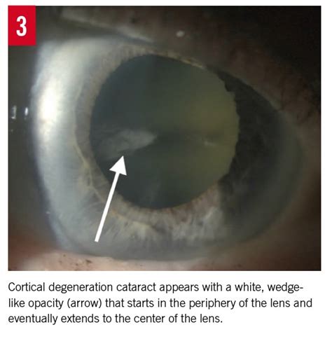 The Aging Crystalline Lens: A Review of Cataracts | Consultant360